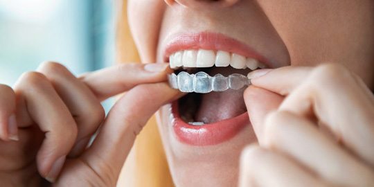 Close up of woman inserting Invisalign