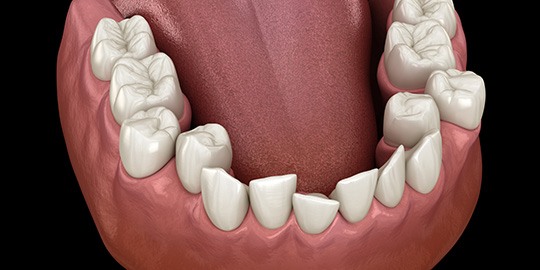 Rendering of crooked teeth and tongue of a lower arch with black background