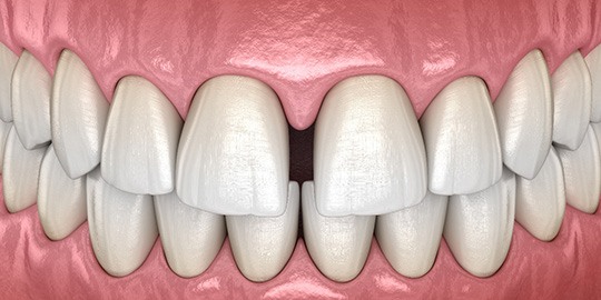 Closeup rendering of a diastema between two top front teeth