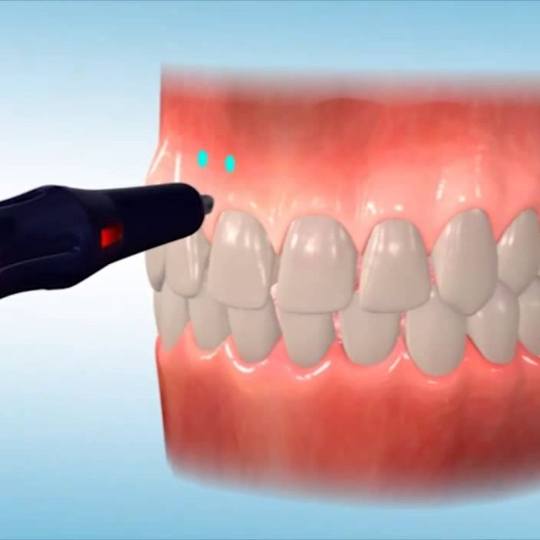 Animated smile during propel accelerated orthodontics treatment